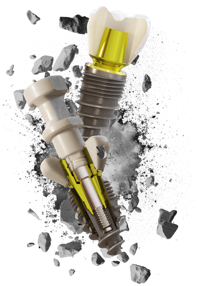 The Champions (R)Evolution Implant