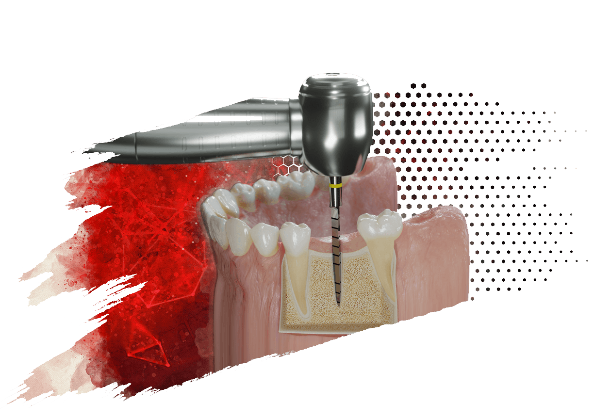 The Minimally Invasive Medical Implantation